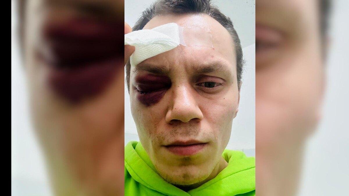Фото: Глаз долой! Бойца ММА лишили зрения в пьяной драке 🤕 - Фото 4